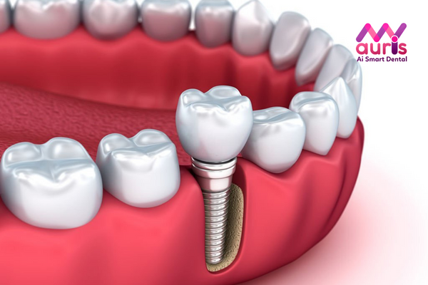 Trồng răng giả bằng trồng răng Implant