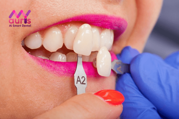 Tìm hiểu quy trình bọc răng sứ cho răng cửa