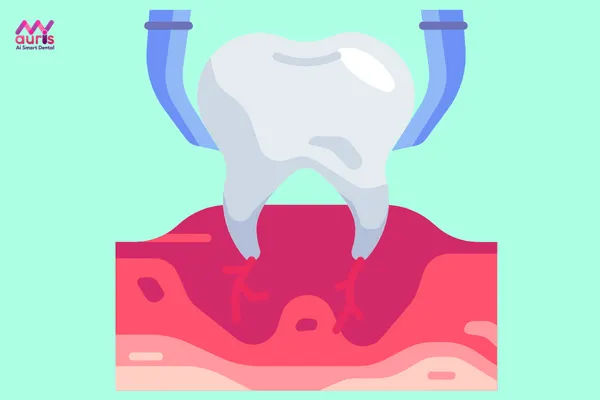 Răng khôn có mấy cái - Có nên nhổ bỏ răng khôn không? 