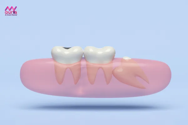 Răng khôn có mấy cái? Gây ảnh hưởng như thế nào? 