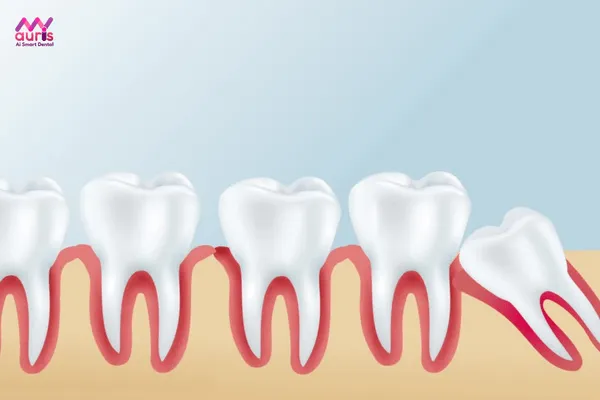 Răng khôn là răng nào? 
