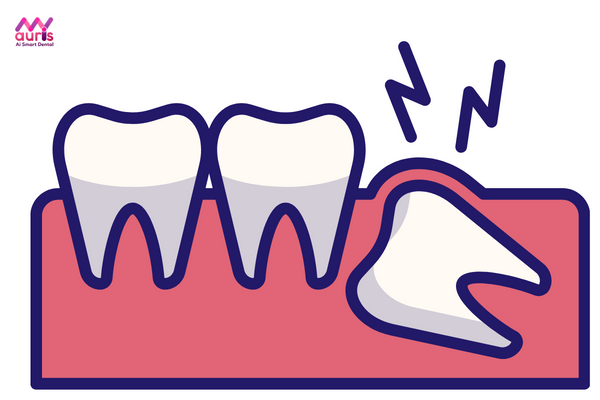 Răng khôn là răng nào - Những cách mọc răng khôn 