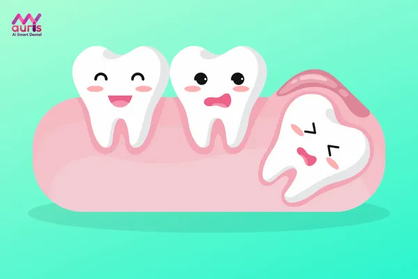 Răng khôn mọc lệch hàm dưới như thế nào?