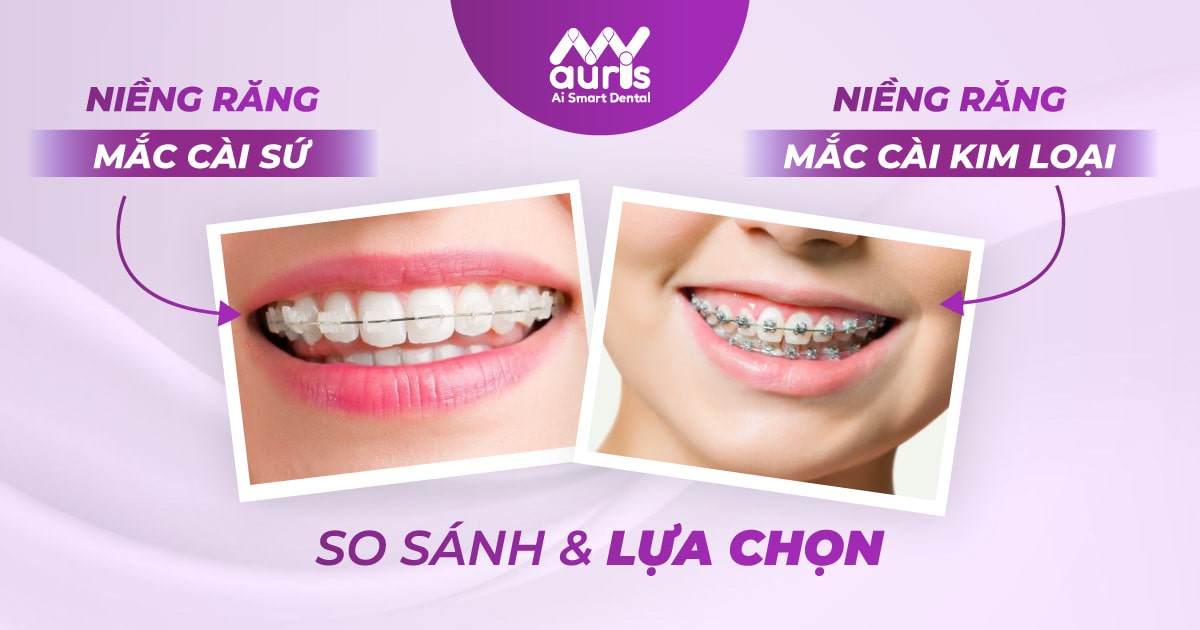 Niềng răng mắc cài sứ và kim loại - So sánh và lựa chọn