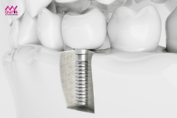 Trồng răng implant là gì? tác hại của việc trồng răng implant