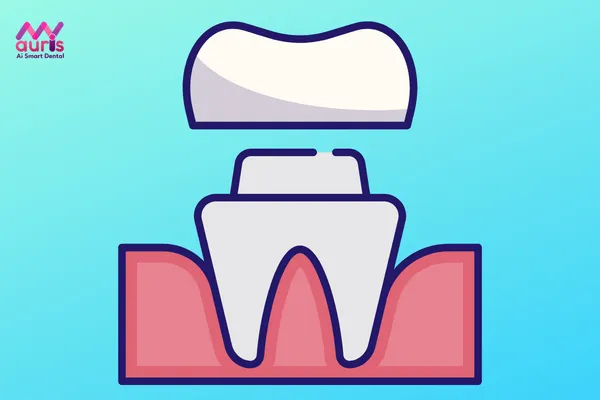 Quy trình bọc răng sứ venus - có nên bọc răng sứ venus