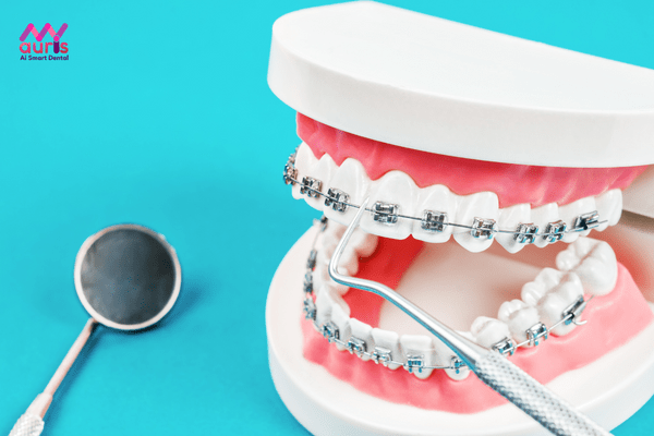 Thời gian niềng răng hô phụ thuộc vào những yếu tố nào? 