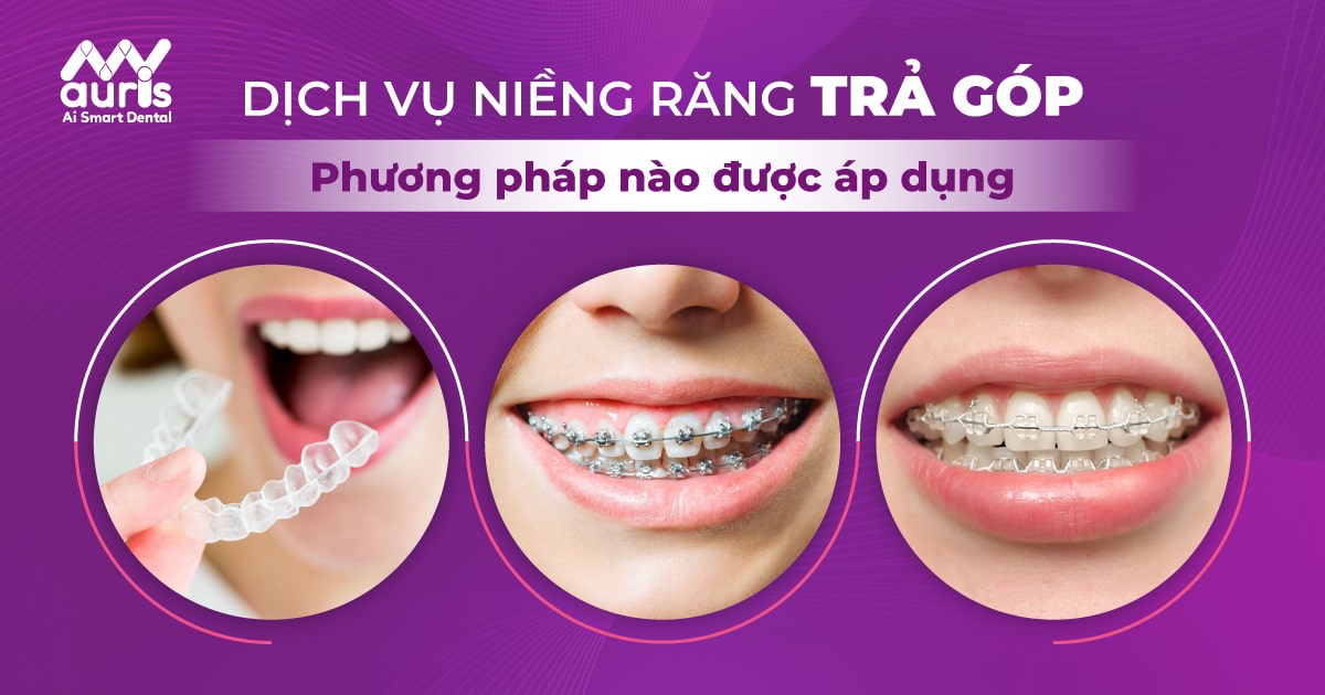 Dịch vụ niềng răng trả góp áp dụng cho phương pháp nào?