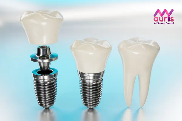 Trồng răng giả giá rẻ bằng phương pháp cấy ghép Implant