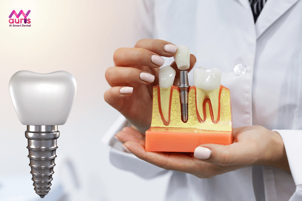 Trồng răng implant là gì? trồng răng implant loại nào tốt