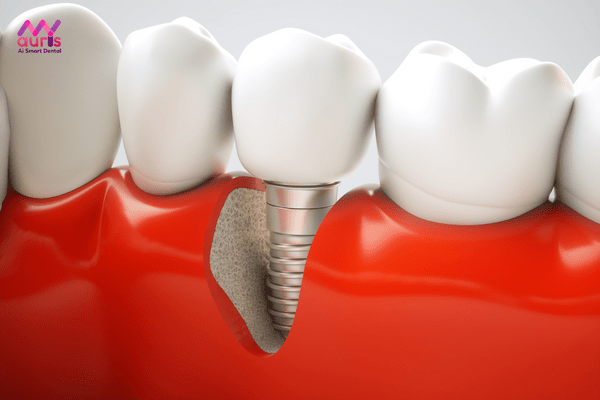 Trồng răng implant loại nào tốt hiện nay?