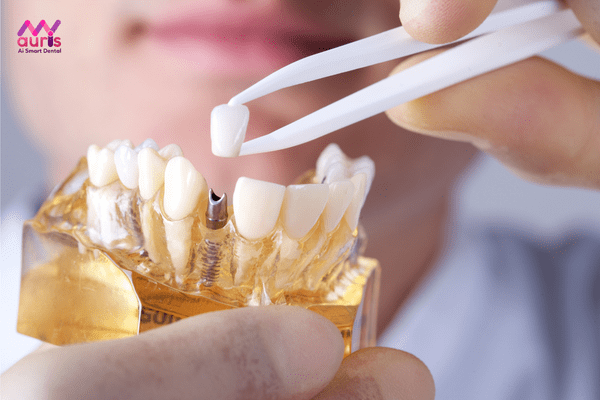 Trồng răng implant là gì? tư vấn trồng răng implant