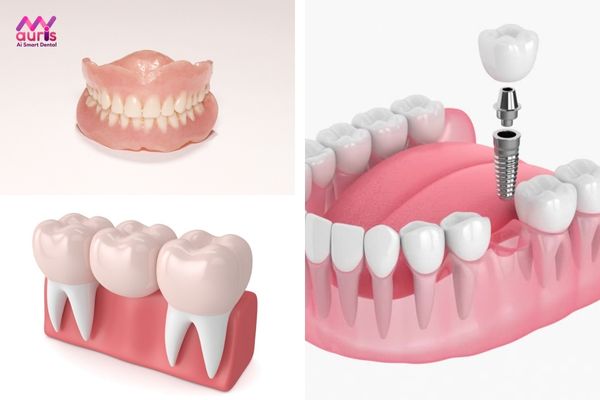 Kinh nghiệm trồng răng giả có các phương pháp nào?