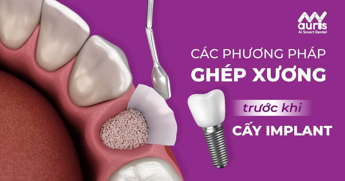 ghép xương bao lâu có thể cấy implant