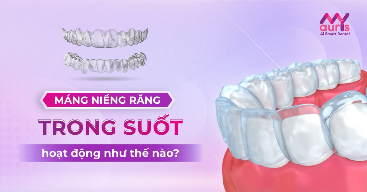 máng niềng răng trong suốt