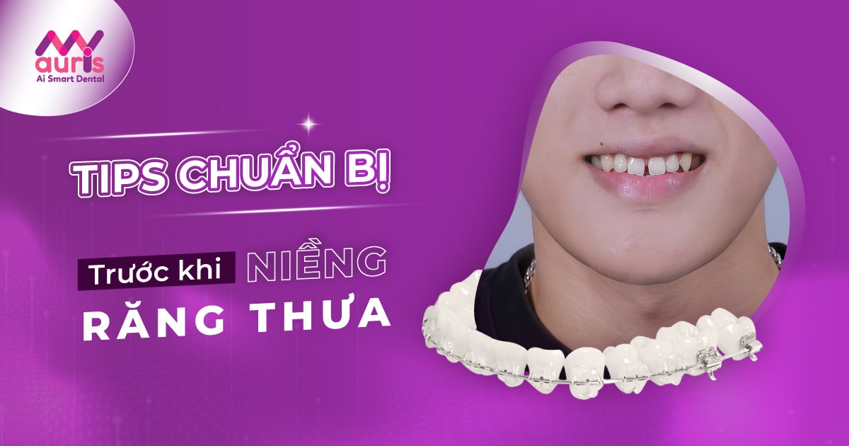 chi phí niềng răng cửa thưa