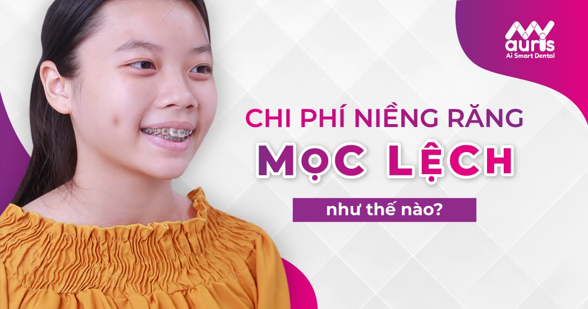 chi phí niềng răng mọc lệch