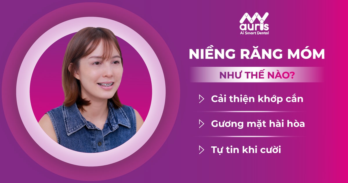 chi phí niềng răng móm