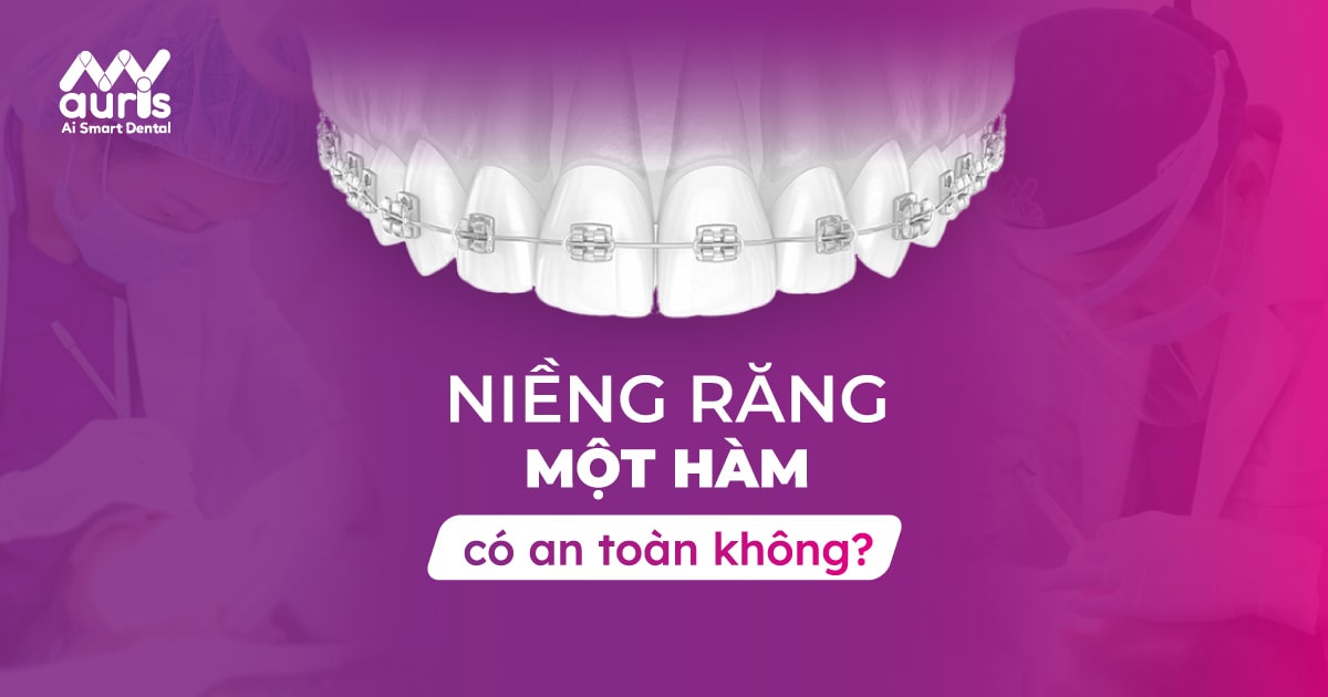 chi phí niềng răng một hàm