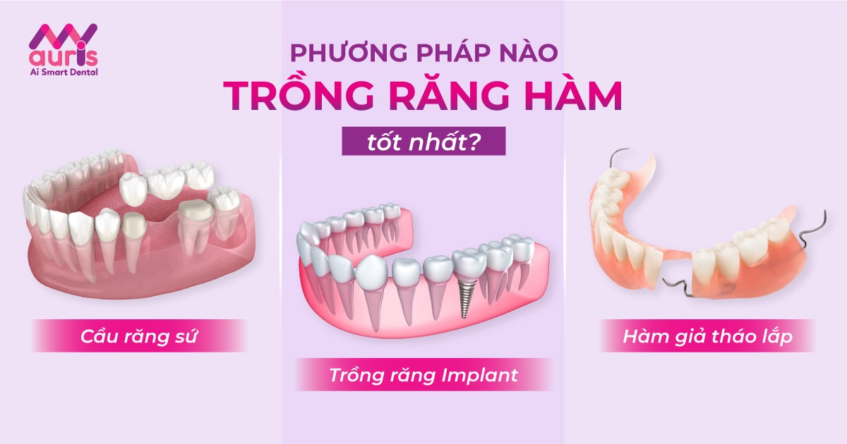 giá tiền trồng răng hàm