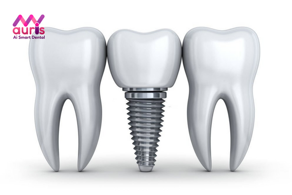 Vì sao cấy răng Implant giá lại cao hơn so với các phương pháp khác?