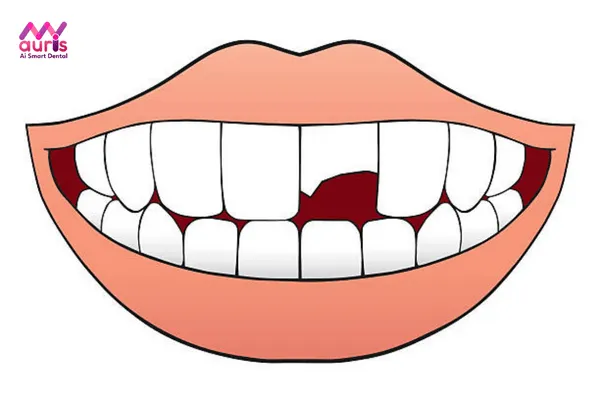 bọc răng sứ cho răng cửa bị mẻ