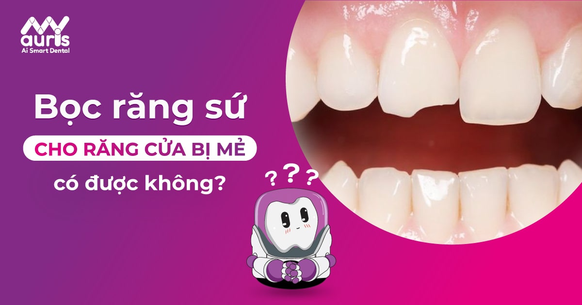 bọc răng sứ cho răng cửa bị mẻ