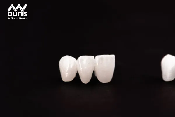 Răng sứ Titanium là răng gì?
