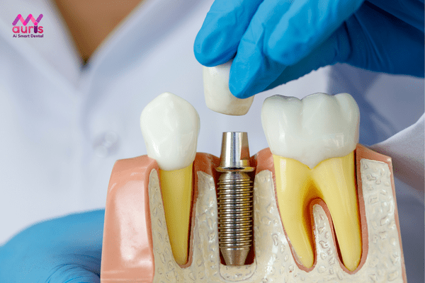 Trồng răng implant - các phương pháp trồng răng giả 