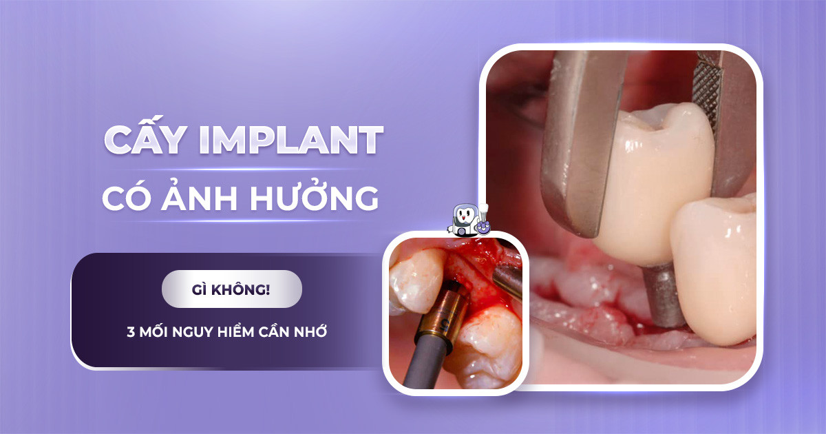 Cấy Răng Implant Có Ảnh Hưởng Gì Không