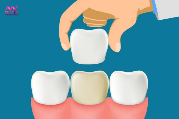 chi phí bọc răng sứ cho răng sâu
