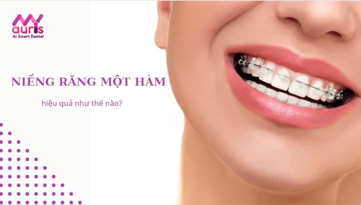 chi phí niềng răng một hàm