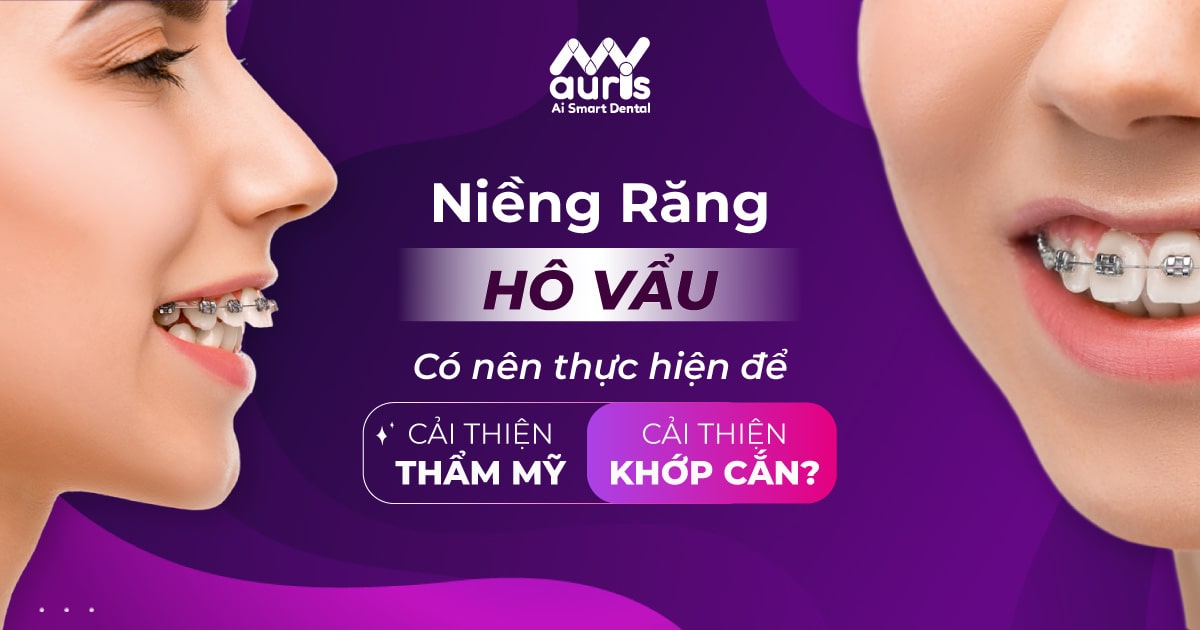 niềng răng hô vẩu