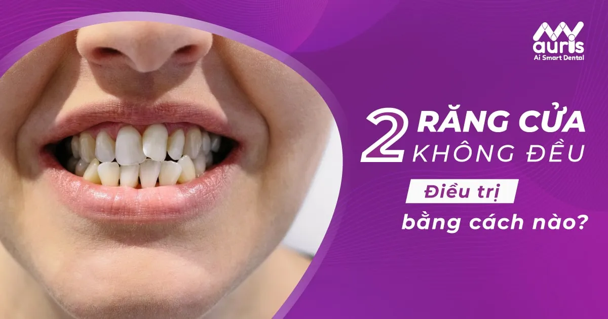 Người có 2 răng cửa không đều thì nên điều trị bằng cách nào?