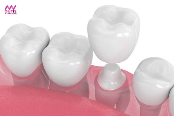 Kỹ thuật bọc 1 răng sứ là gì?