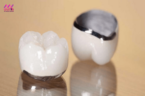 Bọc 1 răng sứ bằng răng sứ kim loại thường