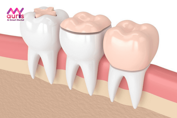 Các trường hợp răng sứ bị hỏng thường gặp