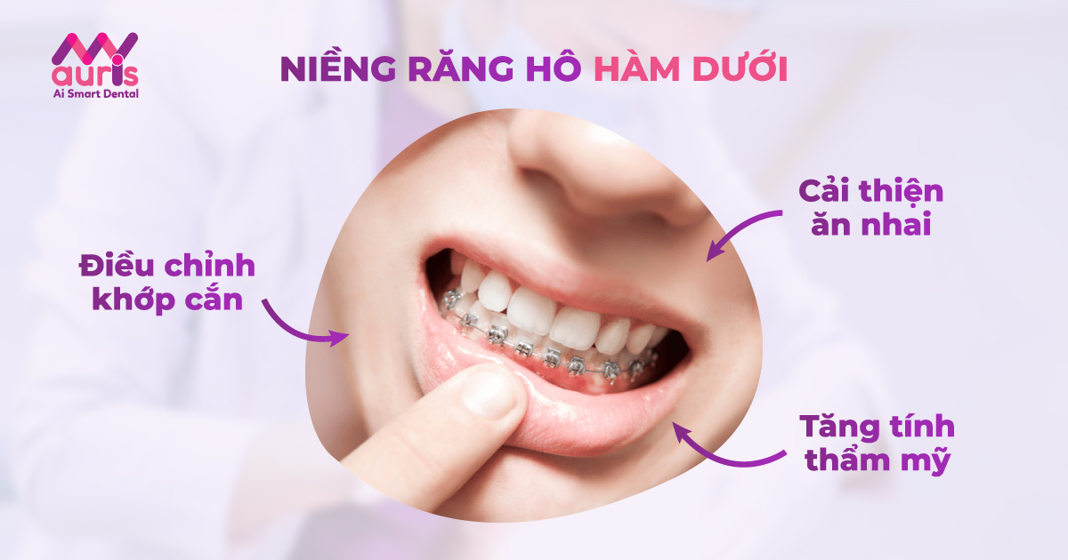 Đặc điểm và cách điều trị răng hô hàm dưới đúng cách