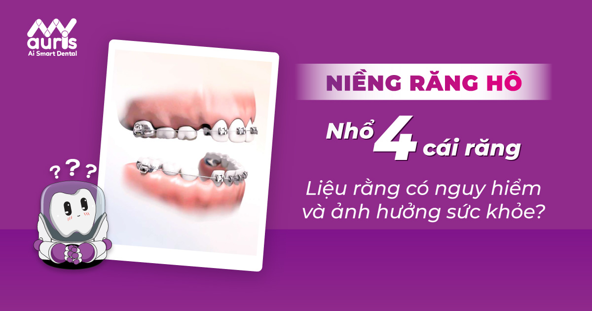 niềng răng hô nhổ 4 cái - Liệu rằng có nguy hiểm và ảnh hưởng sức khỏe?