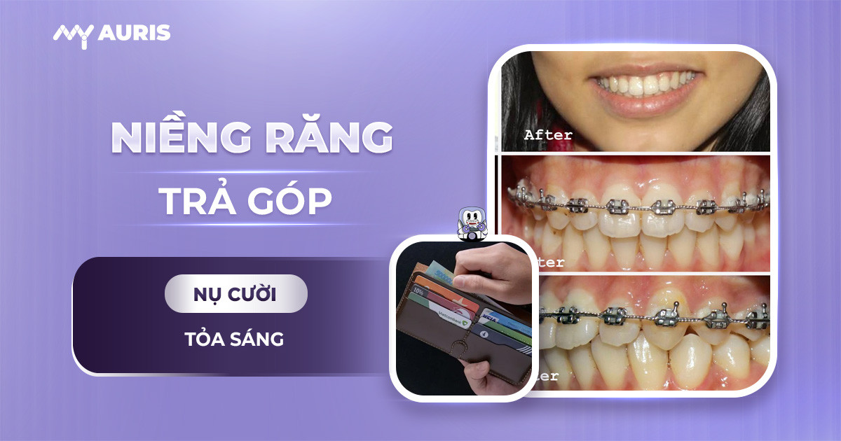 niềng răng trả góp,thủ tục niềng răng trả góp,có nên niềng răng trả góp không,niềng răng hô trả góp,niềng răng mặt trong trả góp,niềng răng trả góp cần giấy tờ gì,thủ tục trả góp niềng răng