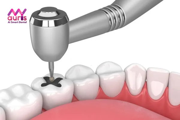 Những tác hại của việc trám răng bạn cần biết