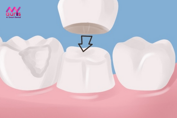 bọc răng sứ 4 răng cửa
