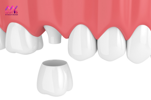 bọc răng sứ 4 răng cửa