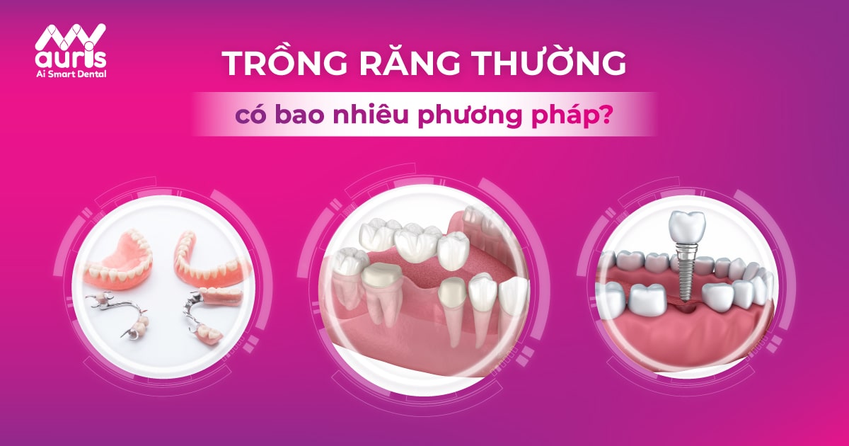 trồng răng thường