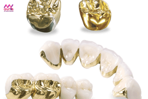 trồng răng vàng 