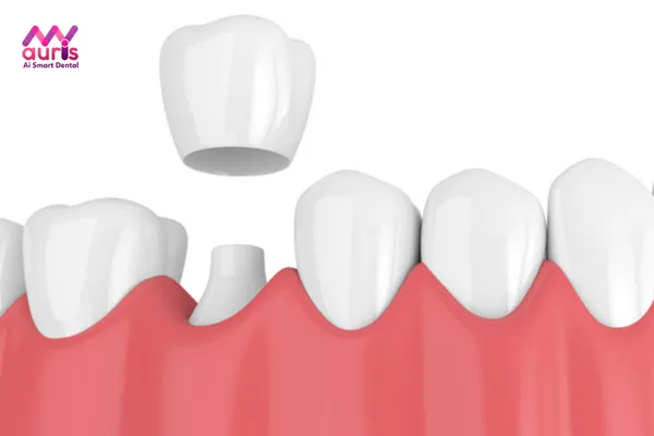 bọc răng sứ cho răng cửa mọc lệch