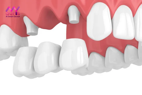 Trồng răng hàm sâu bằng làm cầu răng sứ