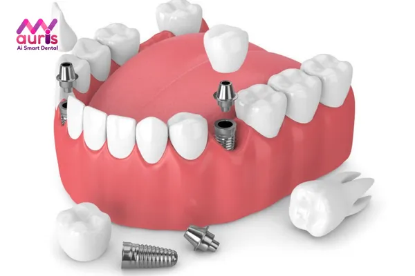 Trồng răng hàm bằng phương pháp Implant là tốt nhất