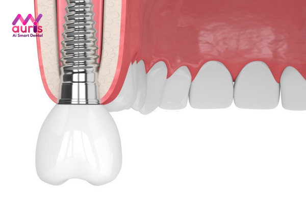 Trồng răng hàm sâu bằng trồng răng Implant