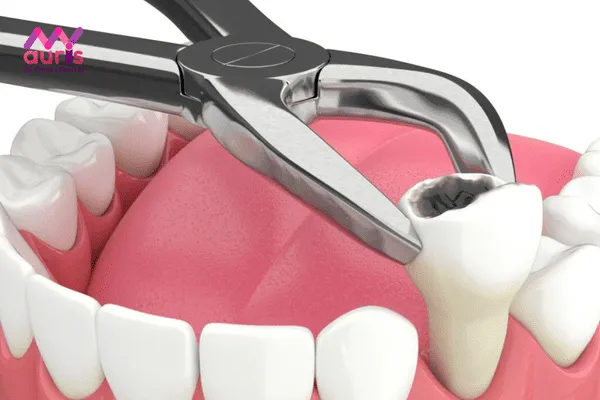Khi nào thì nên nhổ răng hàm?